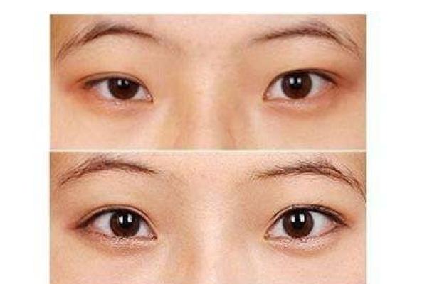 大小眼面相解析：如何从眼部差异看性格与运势