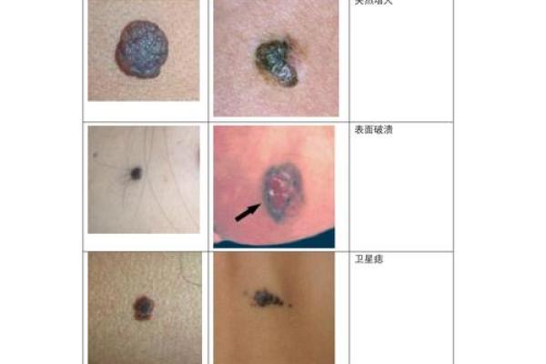 脸上痣相揭秘：凶痣还是福痣，一眼识破