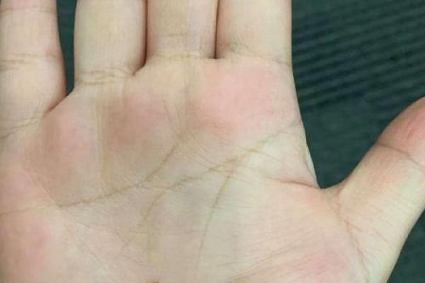 手相痣相揭秘：上边有痣的人命运如何？必看